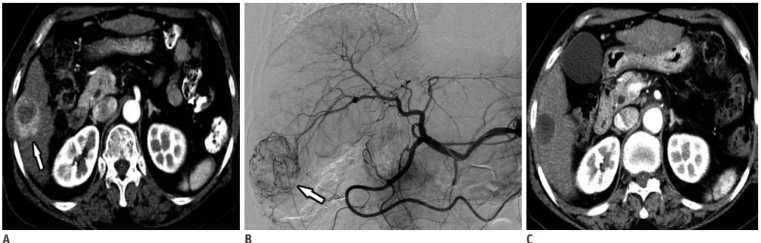Fig. 4. 70-year-old woman with single, intermediate-size HCC (4.3 cm in diameter).