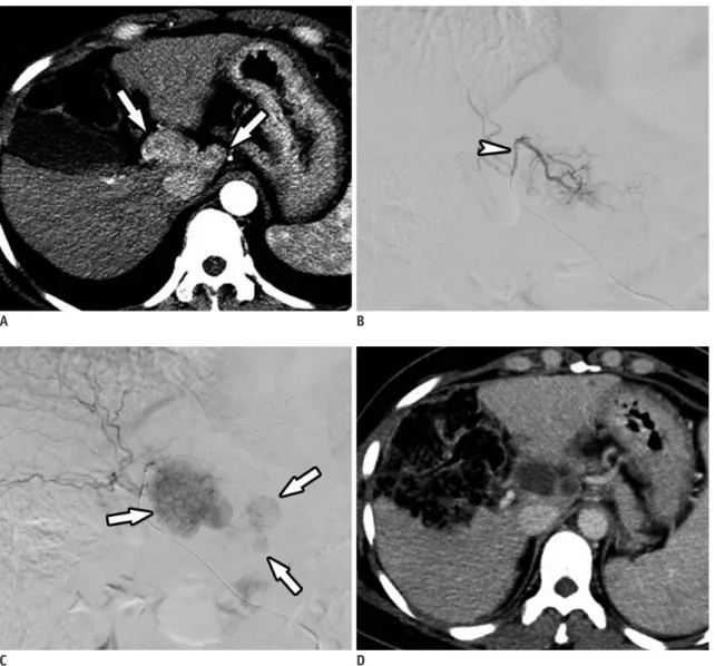 Fig. 5. DC Bead ®  (BTG) TACE as bridge to liver transplantation. 