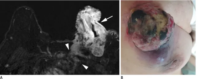 Fig. 4. T4c breast cancer. 