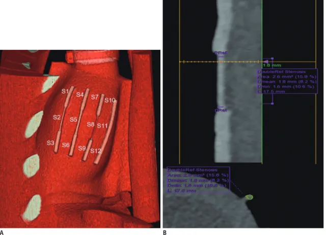 Fig. 2. Volume-rendered curved multiplanar reformatted CT images and transverse section of coronary artery demonstrating  segmentations of coronary arteries and measurement of MlD and MlA.