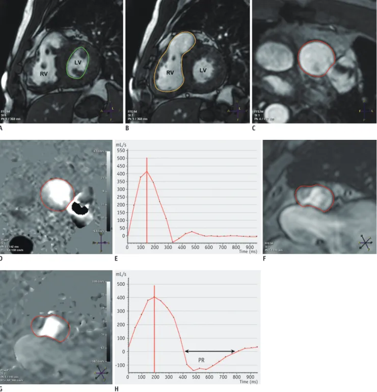 Fig. 2. 36-year-old male patient with repaired tetralogy of Fallot and left pulmonary artery stent placement.
