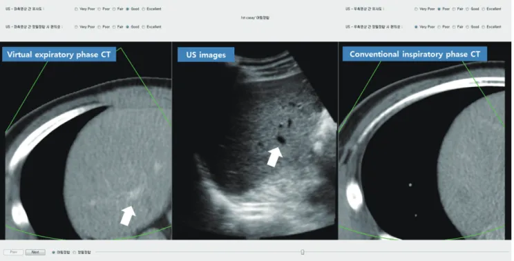 Fig. 1. Pilot study for technical feasibility of Ve-CT images using CI-CT images.  This is initial alignment of fusion imaging between CT  and US images