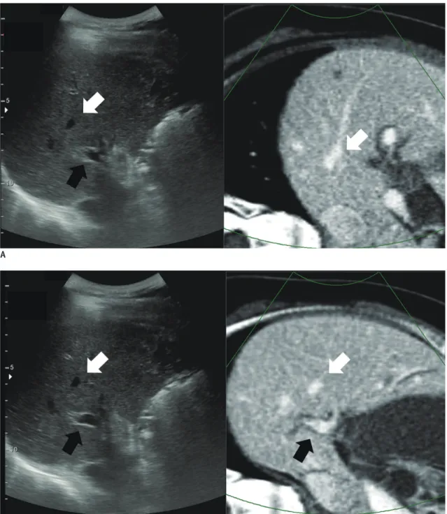 Fig. 5. Improved visual similarity after initial image fusion in Ve-CT/Us fusion imaging
