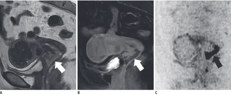 Table 1. Correlations of Different Uterine Cervical Tumorous  Lesions with High-Risk HPV Infection