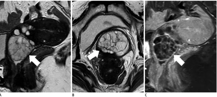 Fig. 12. 53-year-old woman with cervical polyp.