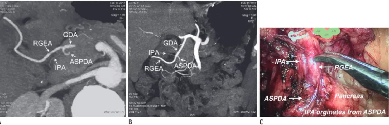 Fig. 1. CTA images show that IPA originated from ASPDA; this was confirmed during surgery