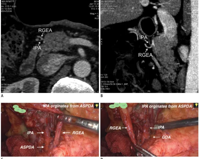 Fig. 3. CTA image of one patient demonstrating origin of IPA to be RGEA; this was not consistent with surgical findings