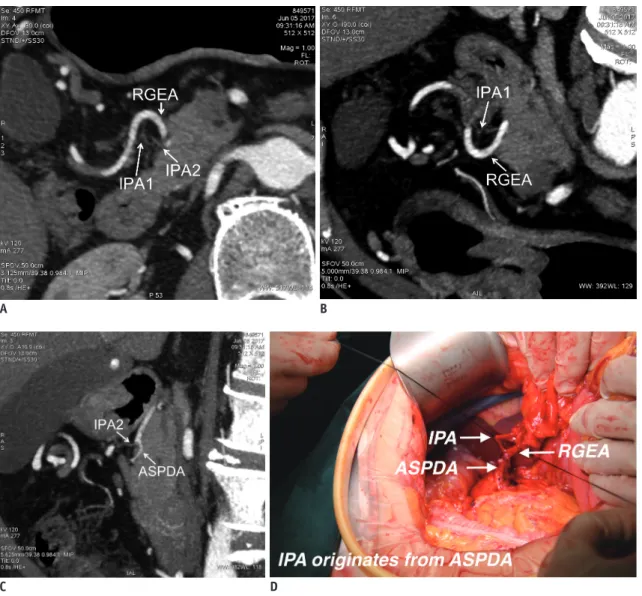 Fig. 4. CTA image of one patient detects two branches of IPA.
