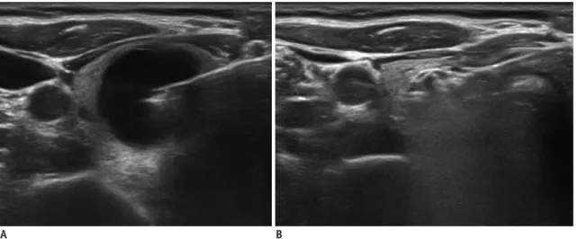 Fig. 1. EA for benign recurrent cyst in right thyroid gland. 