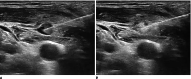Fig. 2. EA for recurrent papillary thyroid carcinoma in right lateral neck. 