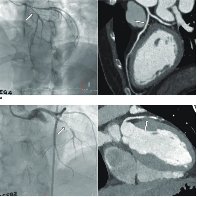 Fig. 3. Difference in severity of spasm between lesions  according to time (from midnight to 10 AM or 10 AM to  midnight) when cCTA was performed.