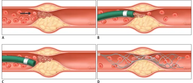 Fig. 2. Illustrations of front-line thrombectomy in EVT for ELVO due to underlying ICAS