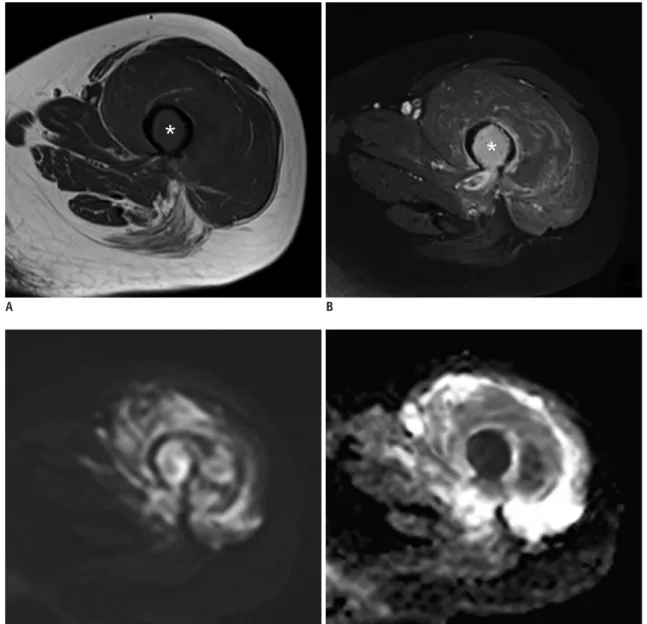 Fig. 2. CE and combined sets demonstrate correct diagnosis of pathologic fracture by both readers at left femur in 55-year-old  woman with multiple myeloma