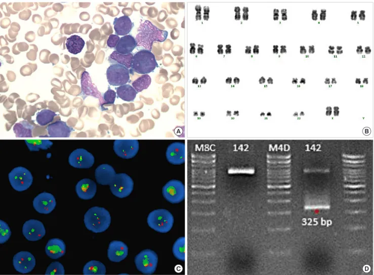 Fig. 1. (A) Granular promyelocytes from bone marrow aspiration smear (Wright-Giemsa stain, ×1,000)