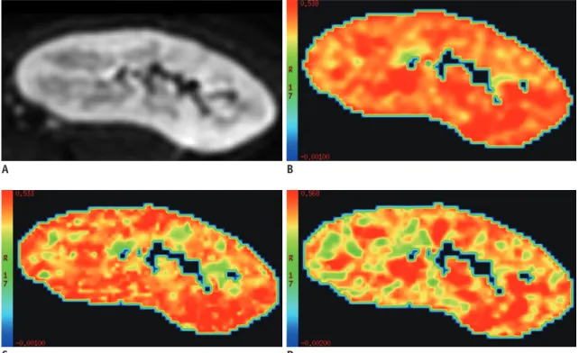 Fig. 3. DKI images and MK, κ ǁ , and κ ⊥ color-coded maps of 35-year-old woman with good renal allograft function (eGFR = 100  mL/min/1.73 m 2 )