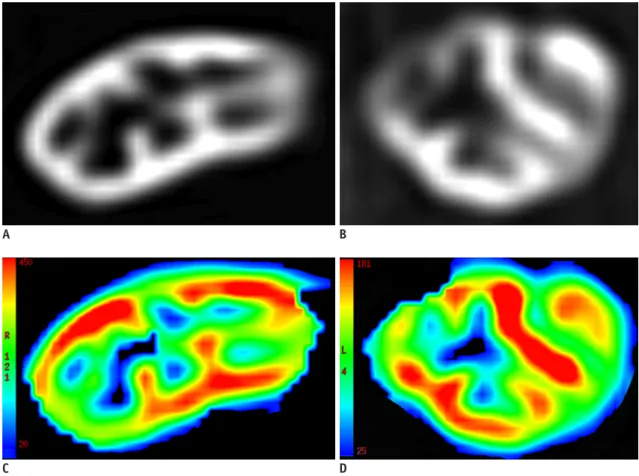 Fig. 5. Comparison of ASL perfusion between patients with good and poor renal allograft function