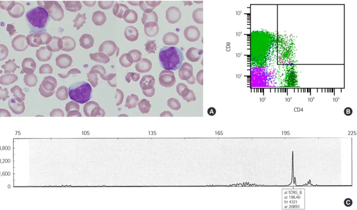 Fig. 1. Representative images of case 21 of Table 1. (A) A peripheral blood smear shows typical large granular lymphocytes with moderate cytoplasm  and fine azurophilic granules