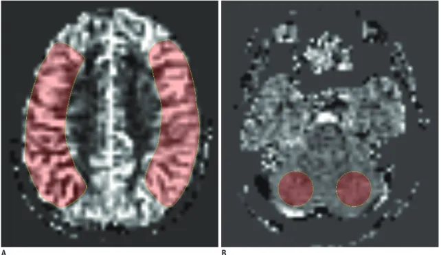 Fig. 1. Imaging example of ROI placement for CBF measurements in ASL images. 