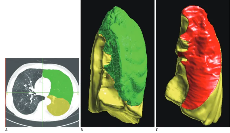 Fig. 1. Semi-automatic lobe segmentation and fissure assessment. 
