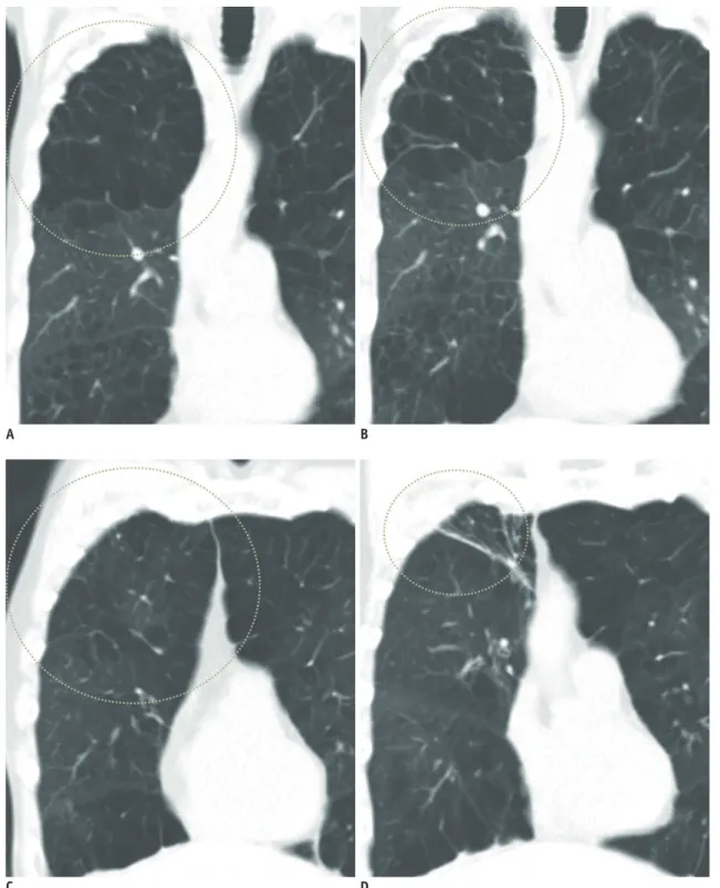 Fig. 4. Some patients showed discrepant results regarding fissure completeness and TLVR after EBV insertion