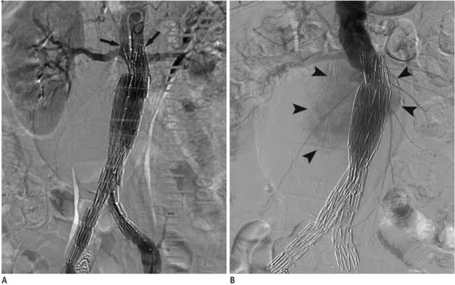 Fig. 11. Delayed stent-graft migration after successful EVAR. 