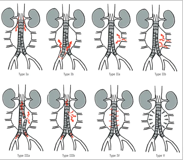 Fig. 12. Diagram showing five different types of endoleaks.