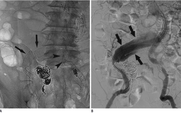 Fig. 16. Delayed AAA rupture after type IIIa endoleak. 