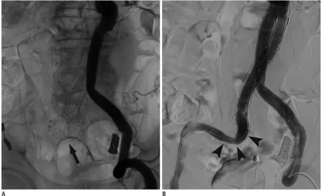 Fig. 18. Stent-graft infection. 