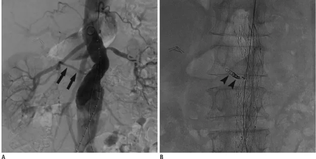 Fig. 6. Aortogram should be obtained to localize orifices  of bilateral renal arteries, prior to stent-graft deployment