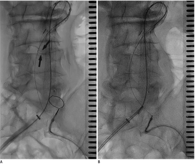 Fig. 7. Gate cannulation with snare technique. 