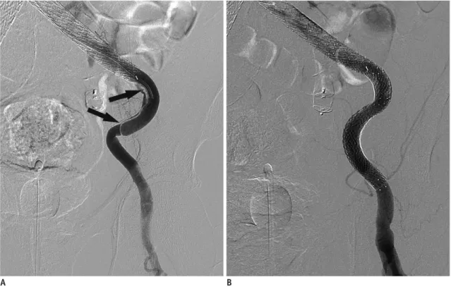 Fig. 10. Right renal infarction after EVAR.  Contrast-enhanced CT  acquired 4 days after EVAR shows right renal infarction with decreased  renal perfusion.