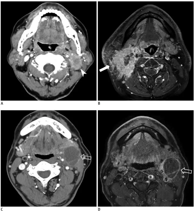 Fig. 2. Representative cases of radiologic ENE in patients with HPV-related OPSCC. 