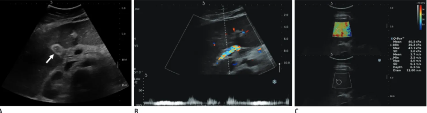 Fig. 9. 13-year-old girl with sinusoidal obstruction syndrome or veno-occlusive disease