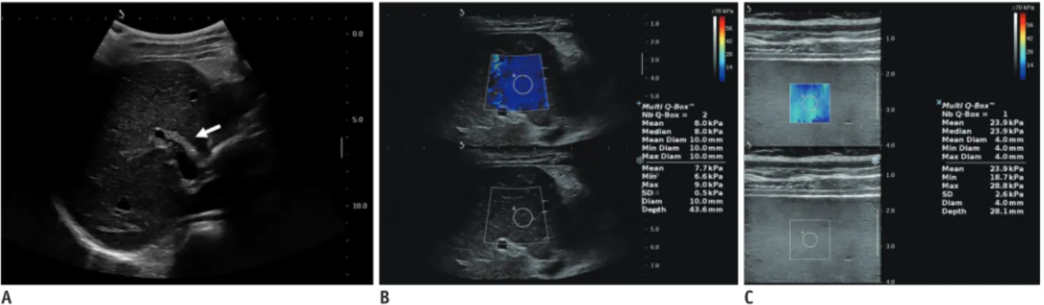 Fig. 4. 12-year-old girl with liver fibrosis after Kasai operation for biliary atresia