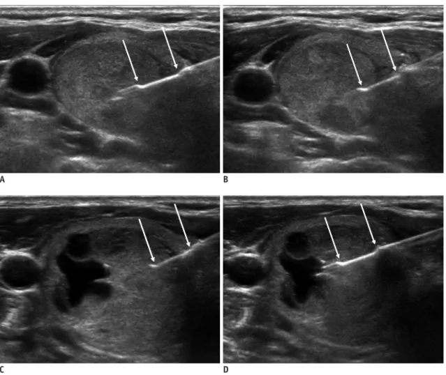 Fig. 2. Two CNB techniques. 