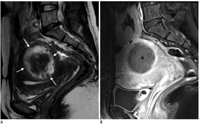 Fig. 2. Leiomyoma with high SI on T2WI. 