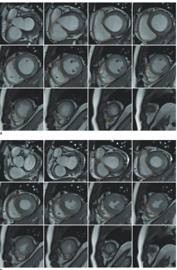 Fig. 3. RV quantitative assessment with short-axis cine images.