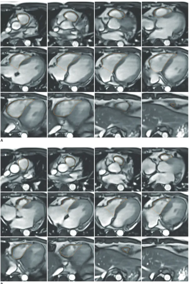 Fig. 4. RV quantitative assessment with transaxial cine images.