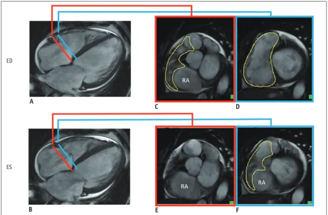 Fig. 5. Pitfall of RV short-axis evaluation: use different planes together. 