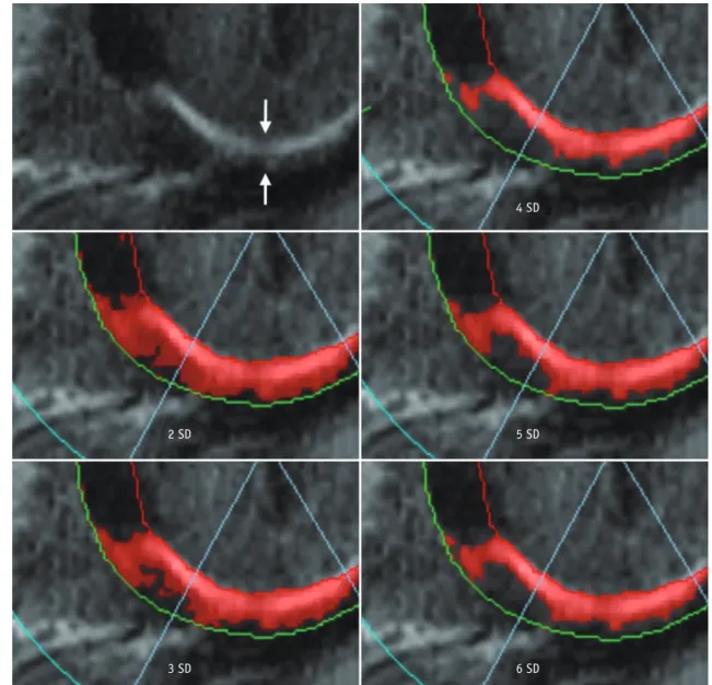 Fig. 12. “n”-SD technique for quantifying LGE extent. LGE image in 57-year-old man with chest pain shows subendocardial infarction  at basal inferior wall of myocardium (arrows)