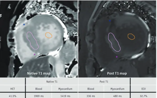 Fig. 13. T1 mapping images of 60-year-old woman with HCM.  After obtaining native T1 and post-contrast T1 values in myocardium and  blood, values and HCT are inserted into ECV formula