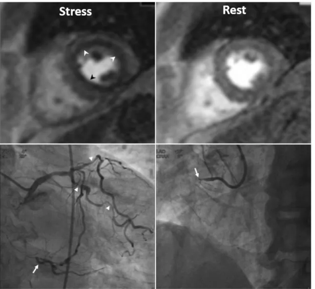 Fig. 2. Three-vessel disease in 70-year-old man.  Ring-like subendocardial perfusion defect (arrowheads) is seen on stress, and disappears  on rest images (upper row)