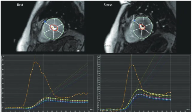 Fig. 7. Example of semi-quantitative perfusion analysis using dedicated software.  Regional maximal up-slope values are demonstrated  based on 17-segment model on time–SI profile