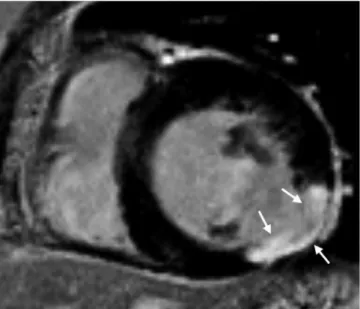 Fig. 8. Role of TI in LGE imaging. 