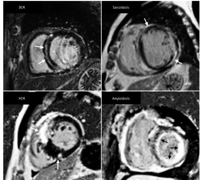 Fig. 10. Short-axis MR images demonstrate LGE pattern in various types of non-ischemic cardiomyopathy