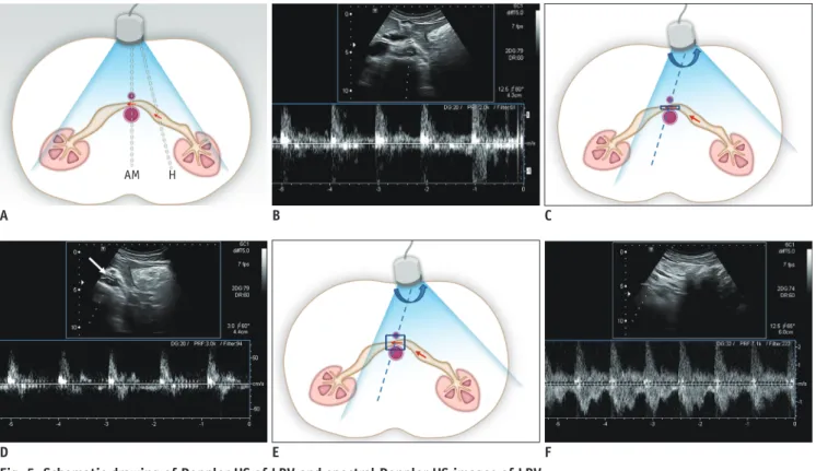 Fig. 5. Schematic drawing of Doppler US of LRV and spectral Doppler US images of LRV. 