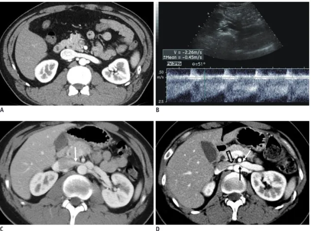 Fig. 7. CECT of kidney in early cortical phase. 