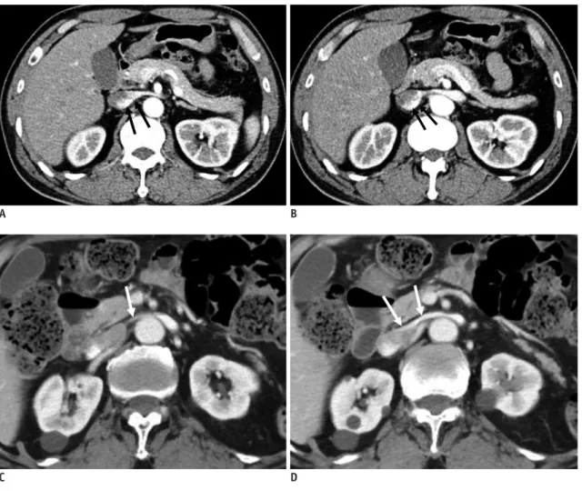 Fig. 8. Preferential flow of contrast-opacified venous flow on CECT. 