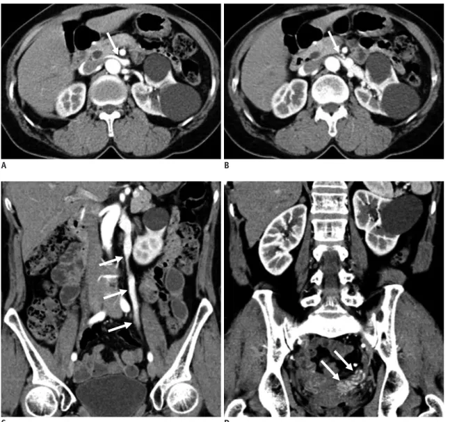Fig. 9. 59-year-old female with concurrent NCS and pelvic congestion syndrome.  Patient complained of persistent microscopic hematuria  and chronic pelvic pain.