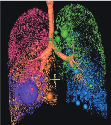 Fig. 1. 3D cluster analysis in patient with severe emphysema. 